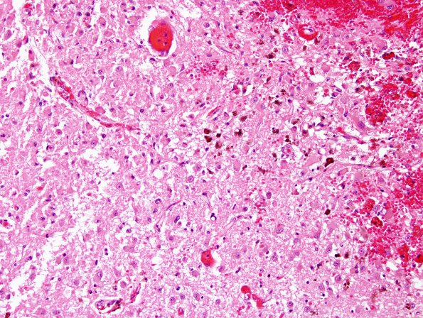 2B4 Wernicke Encephalopathy (Case 2) H&E 1