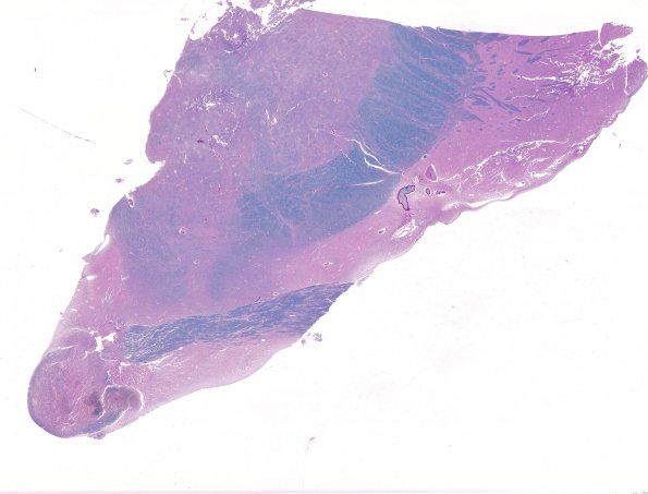 2B5 Wernicke Encephalopathy (Case 2) LFB-PAS whole mount