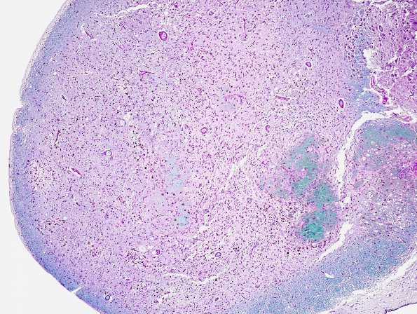 2B6 Wernicke Encephalopathy (Case 2) LFB-PAS 3A