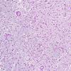 2B7 Wernicke Encephalopathy (Case 2) LFB-PAS 2