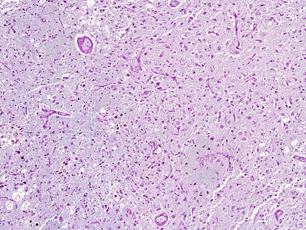 2B7 Wernicke Encephalopathy (Case 2) LFB-PAS 2