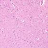 2C Wernicke Encephalopathy (Case 2) Dorsomedian Thalamus H&E 1