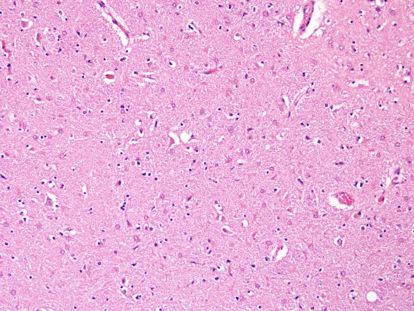 2C Wernicke Encephalopathy (Case 2) Dorsomedian Thalamus H&E 1