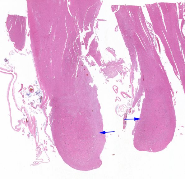 3A1 Wernicke's & Hypoxia-Ischemia (Case 3) H&E whole mount copy