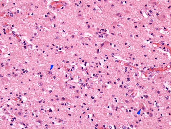 3A3 Wernicke's & Hypoxia-Ischemia (Case 3) H&E 1 copy