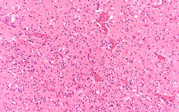 3A4 Wernicke's & Hypoxia-Ischemia (Case 3) H&E 7