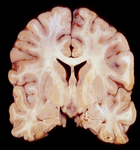 5A1 Wernickes Dz  (Case 5) b