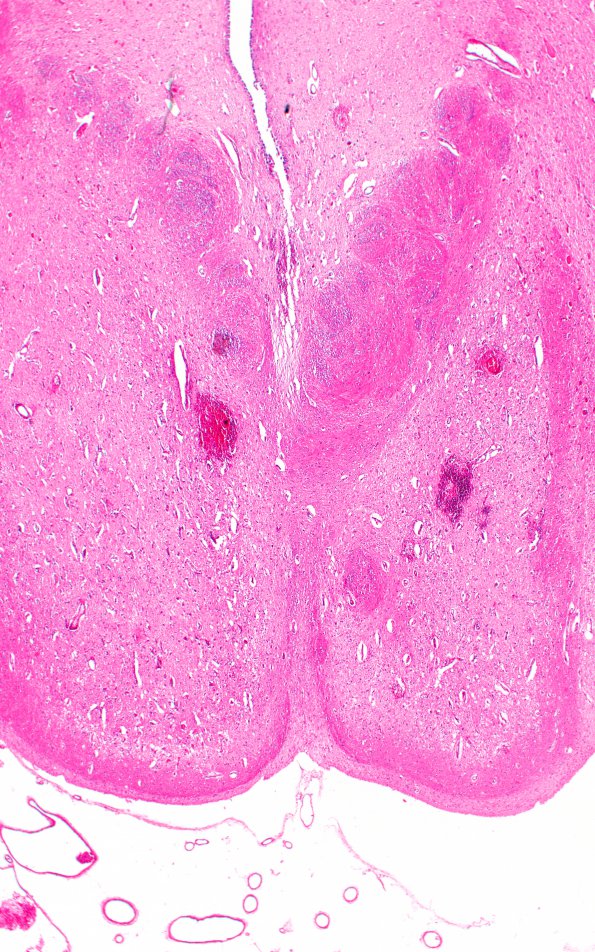 5B2 Wernicke Encephalopathy (Case 5) H&E N11 7