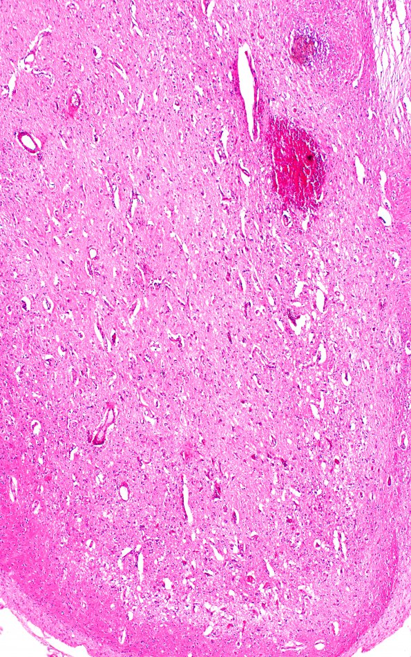 5B3 Wernicke Encephalopathy (Case 5) H&E N11 6