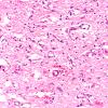 5B4 Wernicke Encephalopathy (Case 5) H&E N11 4