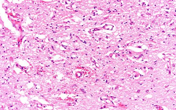 5B4 Wernicke Encephalopathy (Case 5) H&E N11 4