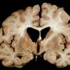 7A1 Wernicke's Encephalopathy (Case 7) Gross 2 copy