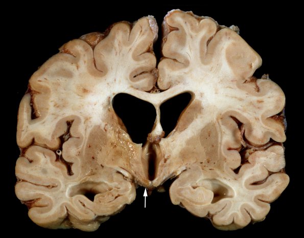 7A1 Wernicke's Encephalopathy (Case 7) Gross 2 copy