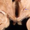 7A2 Wernicke's Encephalopathy (Case 7) Gross 1 copy