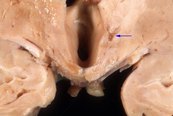 7A2 Wernicke's Encephalopathy (Case 7) Gross 1 copy