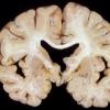 8A1 Question? Wernicke Encephalopathy (Case 8) 2