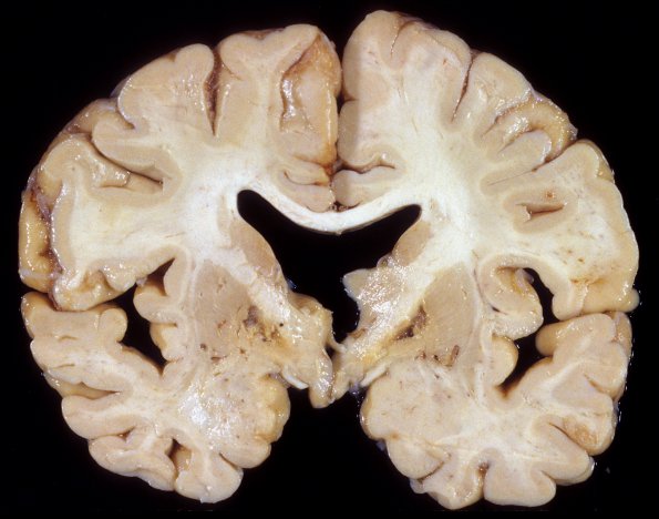 8A1 Question? Wernicke Encephalopathy (Case 8) 2