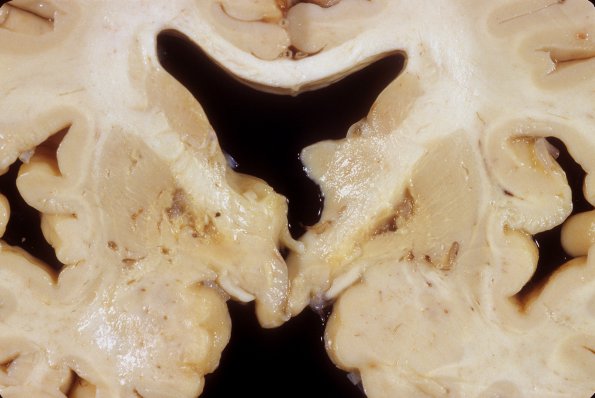 8A3 Wernicke Encephalopathy & lacunes (Case 8) 3