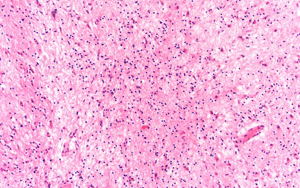 8B2 Question Wernicke Encephalopathy (Case 8) MB 2