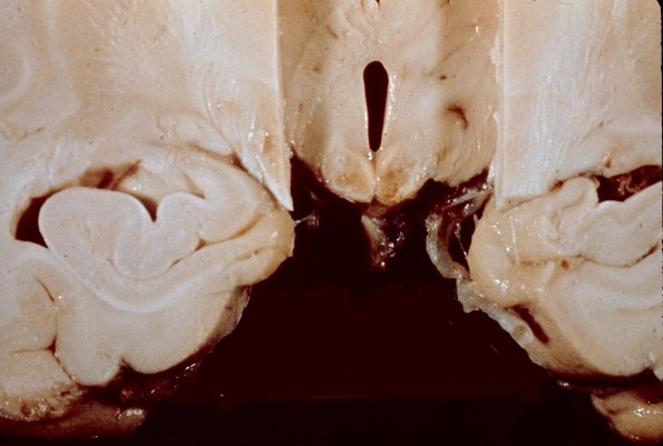 9A1 Wernike's encephalopathy (Case 9)