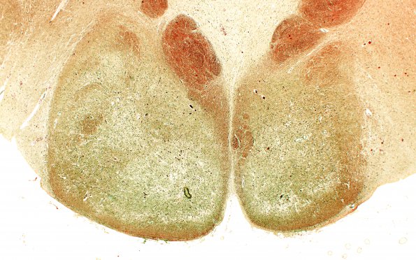 9B2 Wernicke's Encephalopathy (Case 9) Masson 1