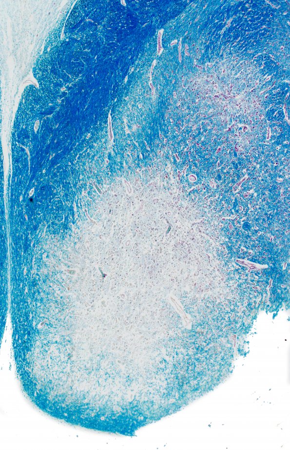 9C1 Wernicke's Encephalopathy (Case 9) LFB-PAS 1