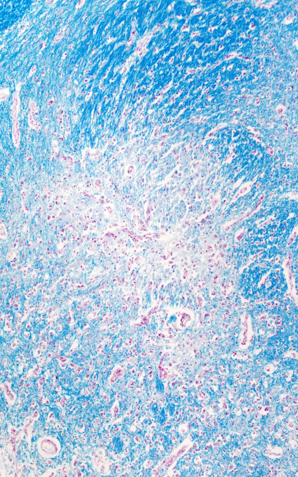 9C2 Wernicke's Encephalopathy (Case 9) LFB-PAS 1