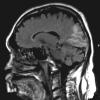 1A1 Amyloidoma, cerebral (Case 1) FLAIR - Copy