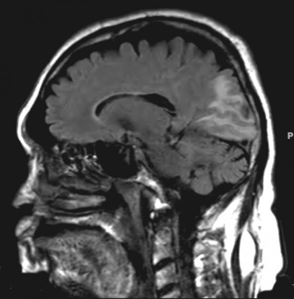 1A1 Amyloidoma, cerebral (Case 1) FLAIR - Copy