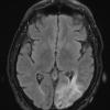 1A2 Amyloidoma, cerebral (Case 1) TIRM Blade without contrast - Copy