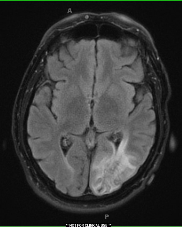 1A2 Amyloidoma, cerebral (Case 1) TIRM Blade without contrast - Copy