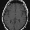 1A3 Amyloidoma, cerebral (Case 1) T1 without contrast - Copy