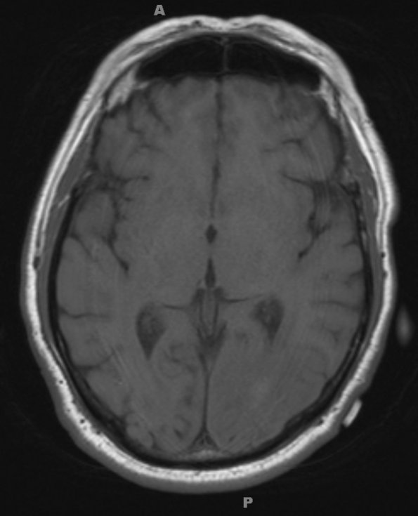 1A3 Amyloidoma, cerebral (Case 1) T1 without contrast - Copy