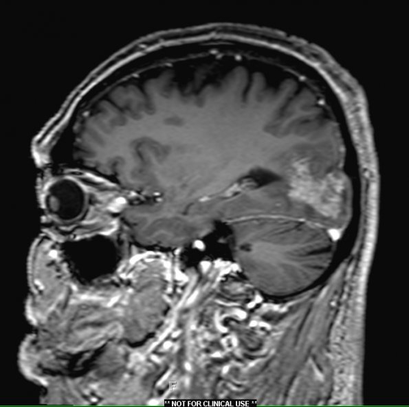 1A4 Amyloidoma, cerebral (Case 1) T1 with contrast 3D POST - Copy