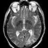 1A5 Amyloidoma, cerebral (Case 1) T2 AX & C - Copy