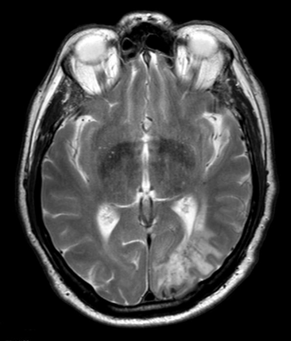 1A5 Amyloidoma, cerebral (Case 1) T2 AX & C - Copy