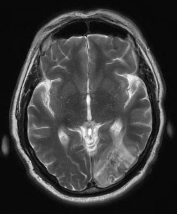 1A6 Amyloidoma, cerebral (Case 1) TRA T2 TSE BLADE & C - Copy