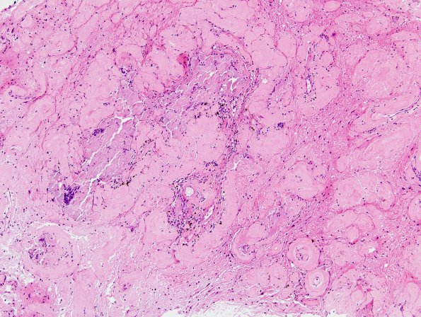 1B1 Amyloidoma, cerebral (Case 1) H&E 2