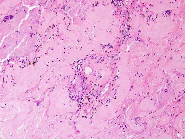 1B2 Amyloidoma, cerebral (Case 1) H&E 3