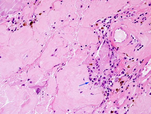 1B3 Amyloidoma, cerebral (Case 1) H&E 7 copy