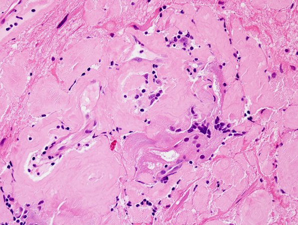 1B5 Amyloidoma, cerebral (Case 1) H&E 6