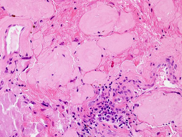 1B6 Amyloidoma, cerebral (Case 1) H&E 10