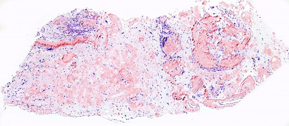 1C1 Amyloidoma, cerebral (Case 1) Congo Red 17