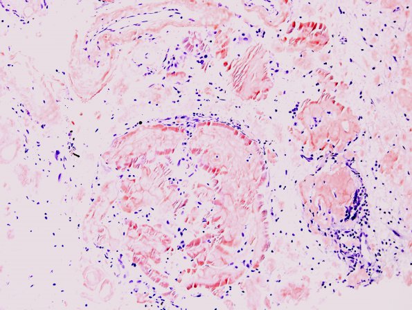 1C4 Amyloidoma, cerebral (Case 1) Congo Red 5