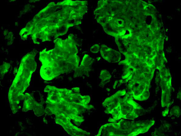 1D2 Amyloidoma, cerebral (Case 1) 1424