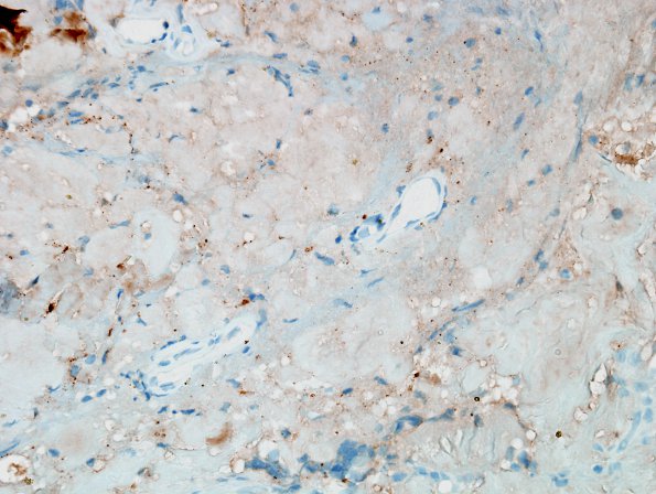 1E1 Amyloidoma, cerebral (Case 1) Kappa 2