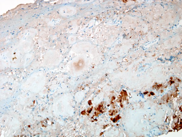 1E2 Amyloidoma, cerebral (Case 1) Kappa 5