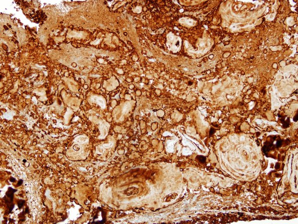 1F1 Amyloidoma, cerebral (Case 1) Lambda 2