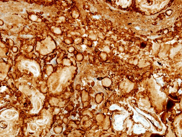 1F2 Amyloidoma, cerebral (Case 1) Lambda 1