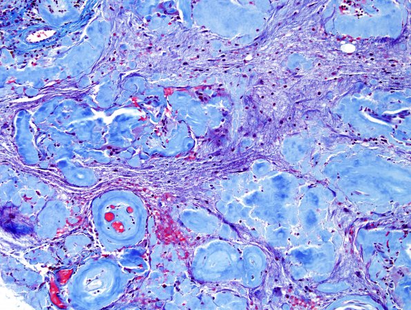 1G1 Amyloidoma, cerebral (Case 1) Trichrome 2